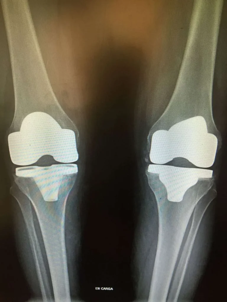 ¿Es necesario ir al fisioterapeuta tras una prótesis de rodilla?