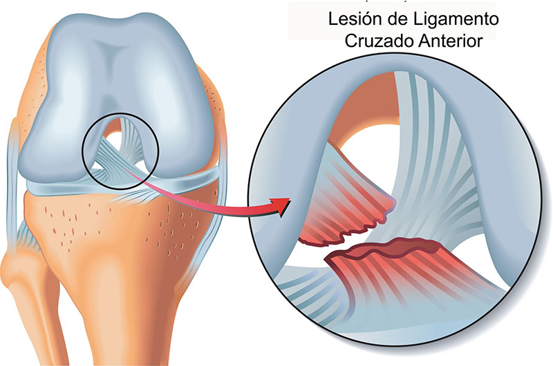 qué es el ligamento cruzado anterior y por qué es tan importante